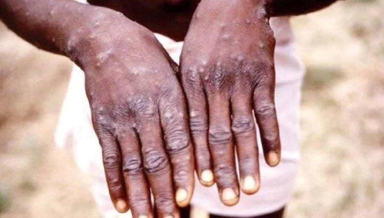 ganada m cicegi vaka sayisi 565e cikti 3CgqRkIh